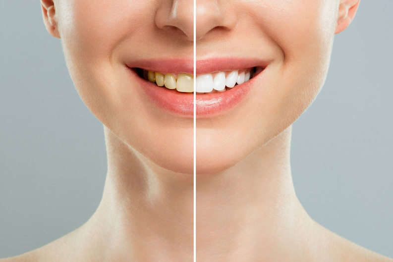 El blanqueamiento dental es un procedimiento popular que se utiliza para aclarar el color de los dientes y lograr una sonrisa más blanca y brillante