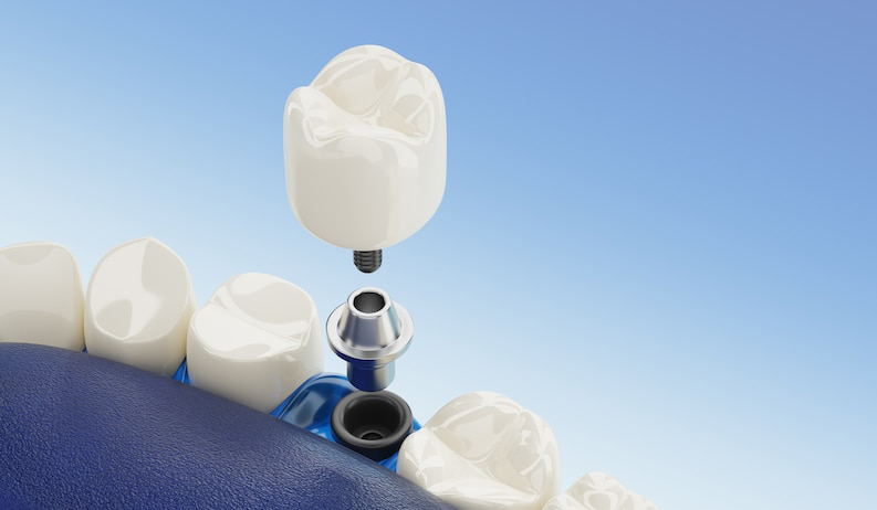 Los implantes dentales han revolucionado el campo de la odontología restauradora, brindando una solución permanente y efectiva para reemplazar dientes perdidos.