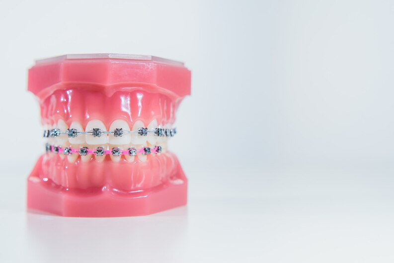 La ortodoncia es un campo de la odontología que se dedica al estudio y tratamiento de las maloclusiones y problemas de alineación dental.
